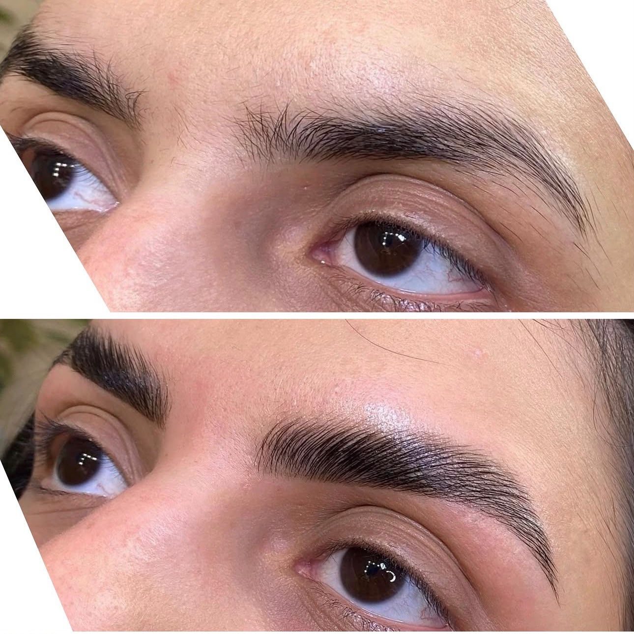 Antes e depois de microagulhamento realizado no Studio Áurea, em Resende