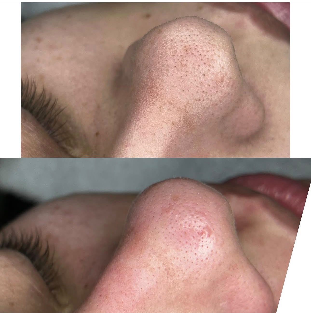 Antes e depois de limpeza de pele realizada no Studio Áurea, em Resende
