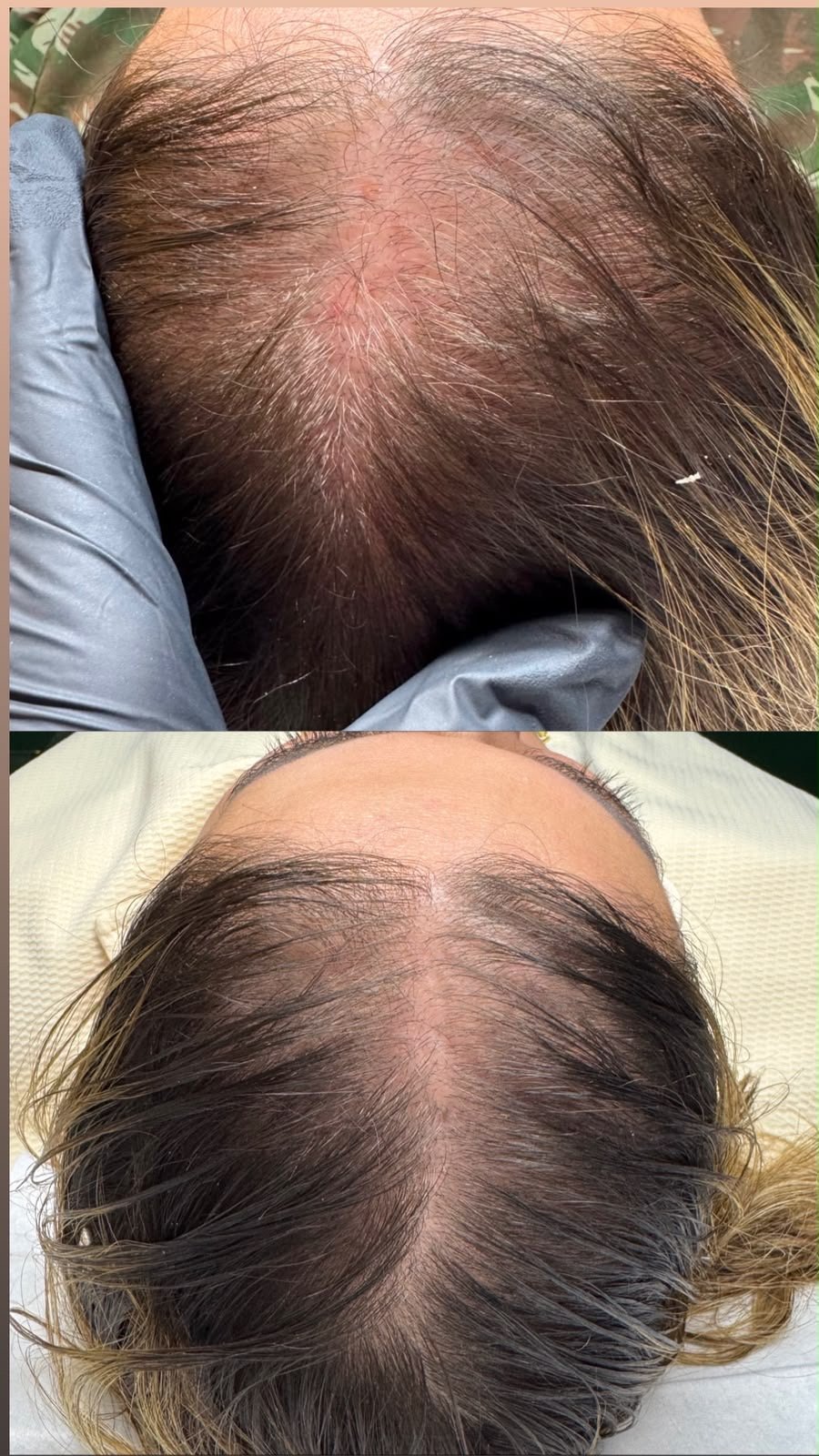 Antes e depois de um tratamento de terapia capilar no Studio Áurea, em Resende — couro cabeludo com mais densidade e repartição menos aparente