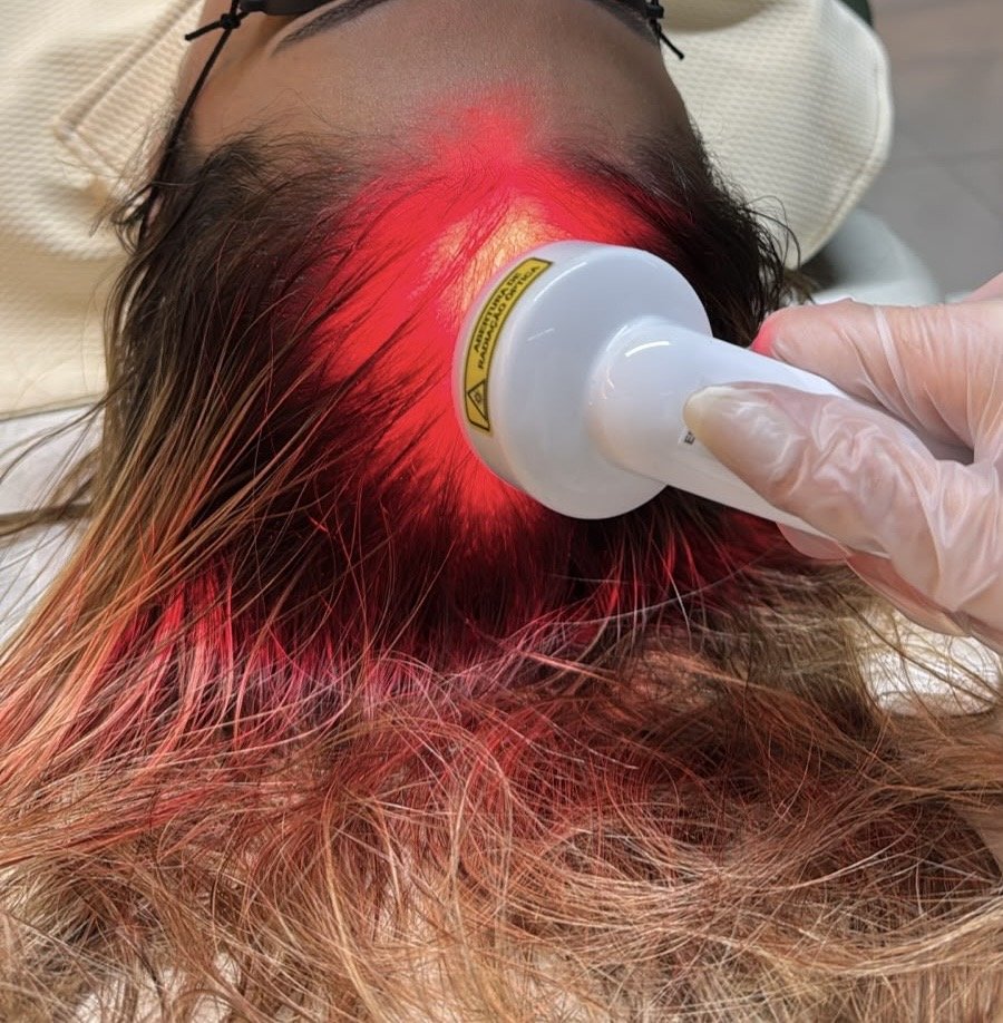 Aplicação de fotobiomodulação a laser no couro cabeludo durante a terapia capilar no Studio Áurea, em Resende